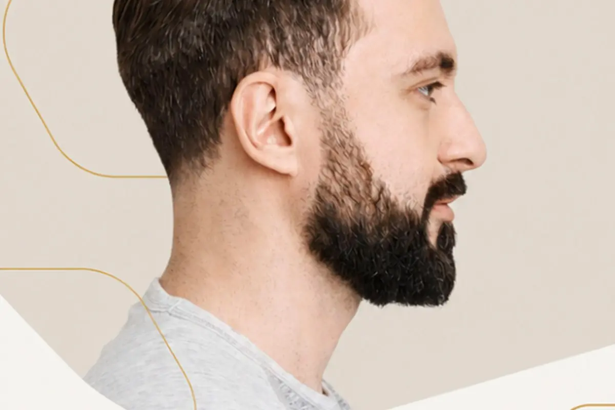 Transplante de Barba e Bigode