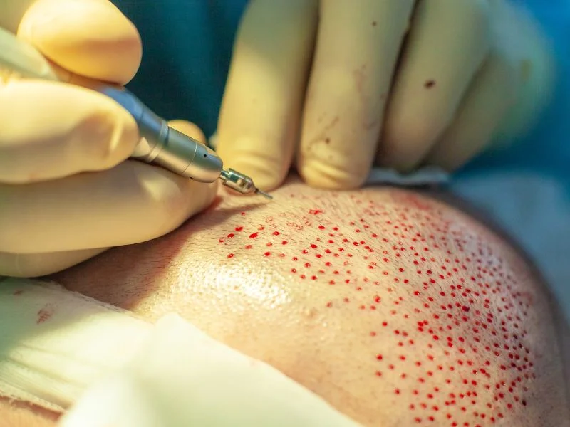 Extração de Unidade Folicular (FUE)